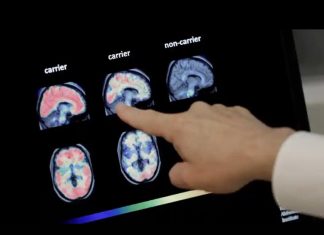 هوش مصنوعی در تشخیص زوال عقل