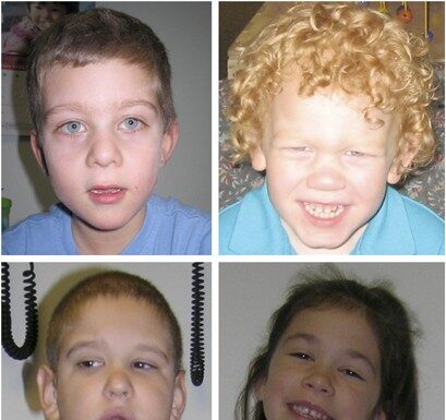 کانالوپاتی در سندرم X شکننده