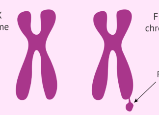 سندروم X شکننده