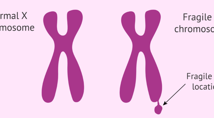 سندروم X شکننده