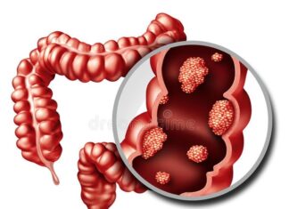 سرطان روده بزرگ