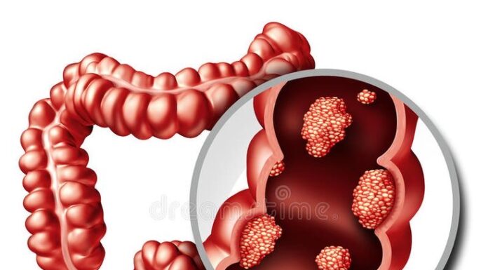 سرطان روده بزرگ