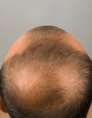 آلوپسی آندروژنتیک